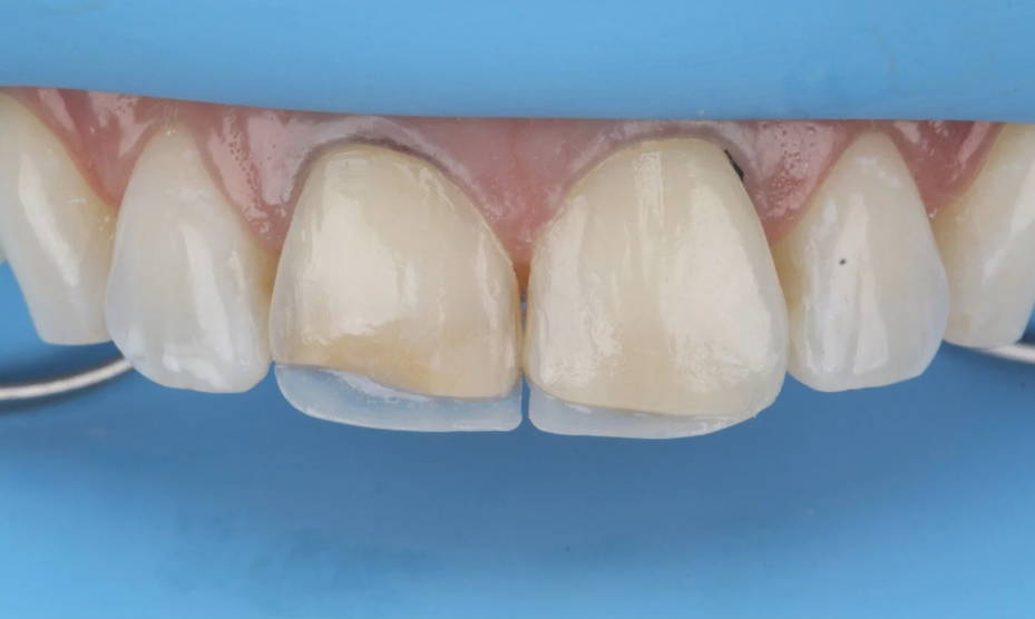 lingual shell created under two frontal teeth