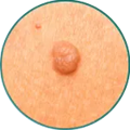 light moles