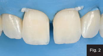 Once the old restorations are removed and the teeth are rendered back to their original state, the degree of proximal and incisal translucency can be evaluated (Fig. 2). 