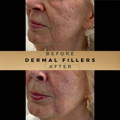 Cheek Fillers Wilmslow