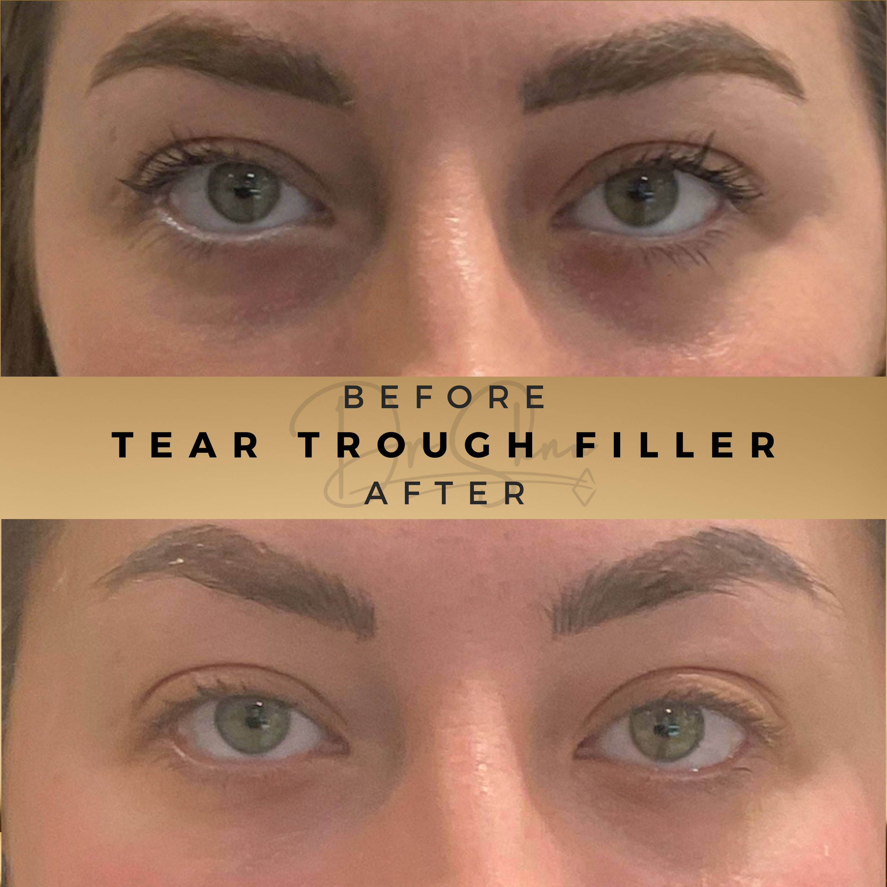 tear trough fillers