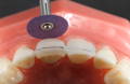 Purple polisher polishing central incisor