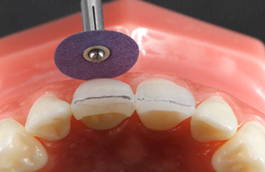Purple polisher polishing central incisor