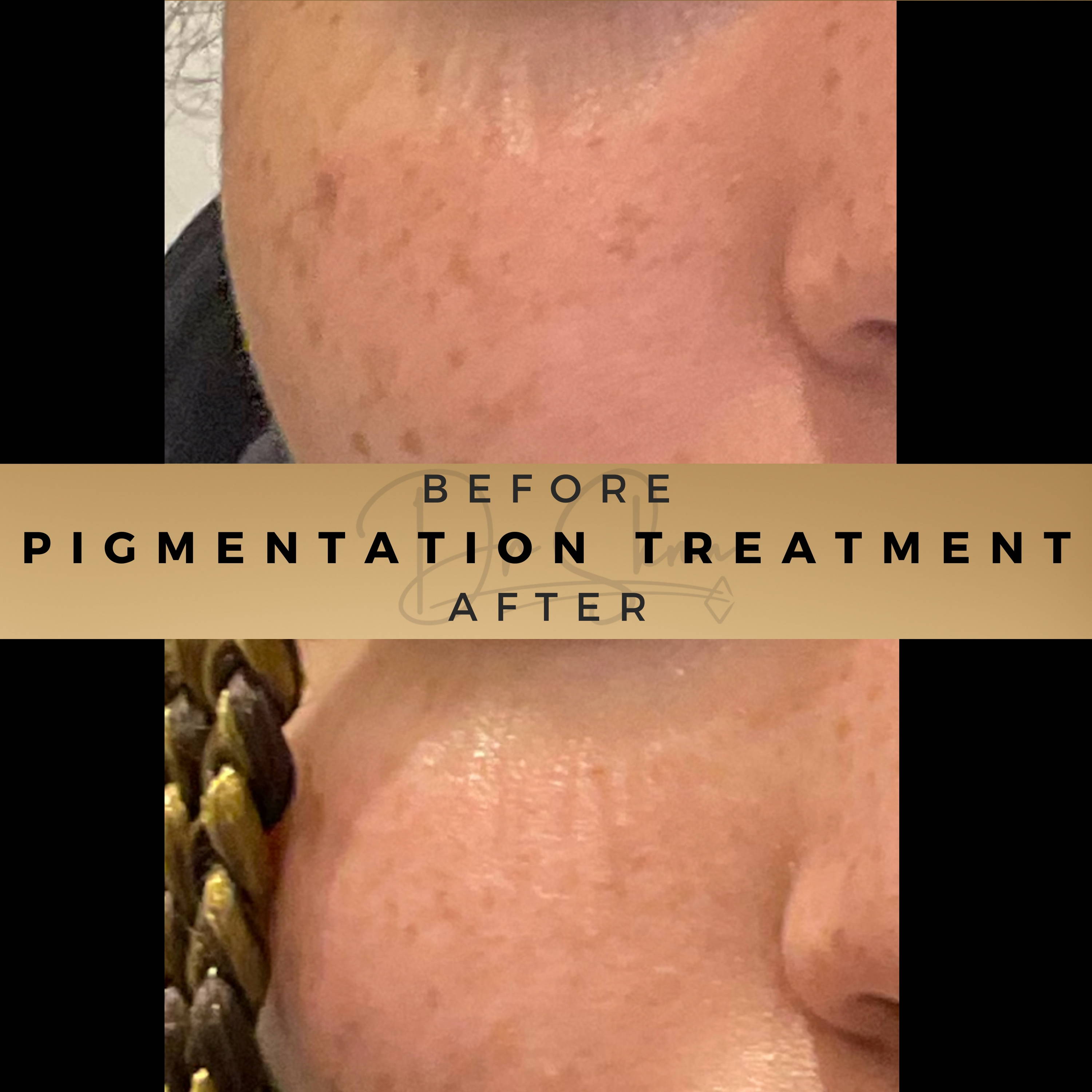 Pigmentation Treatment Wilmslow Before & After Dr Sknn