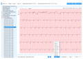 EKG/EKG-Wellenform mit 12 Ableitungen