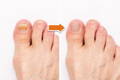 Animated Toenail Fungus