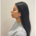 Dermal Fillers - Cheek & Chin Dermal Fillers - After