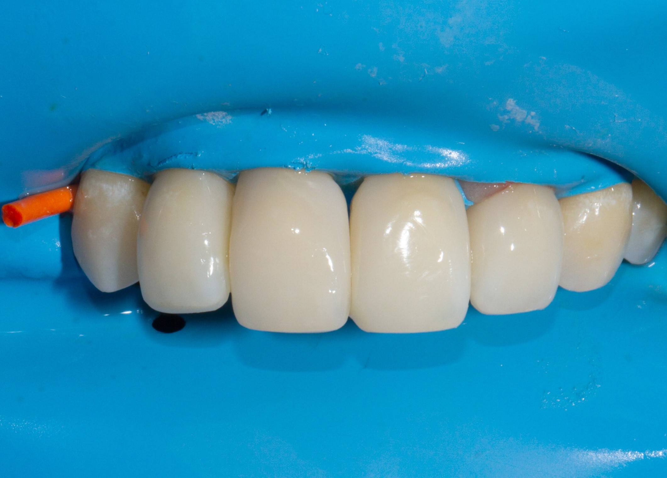Upper teeth isolated with rubber dam after restorative procedure