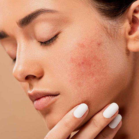 Face Mapping : d'où vient l'acné sur ton visage ? – s-and-vae.com