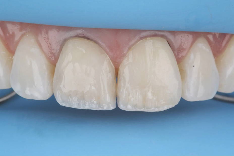 teeth undergoing restoration