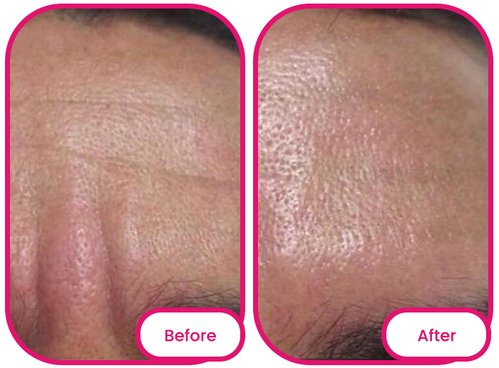 the forehead before and after taking the best collagen gummies singapore