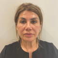 Dermal Fillers - Cheek, Nasolabial & Jowl Fillers - Before