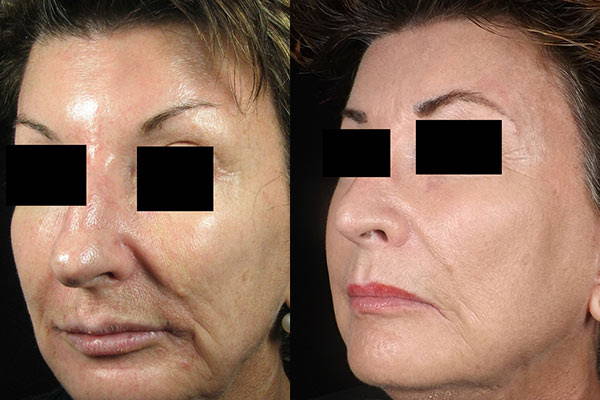 PDO Thread Lifts, Before & After Treatment, Medicetics London