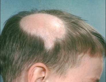 Dr. Kaplan – Alopecia Areata - KAPLAN MD SKINCARE