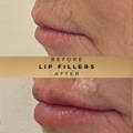Lip Fillers Wilmslow with Anti-wrinkle injections