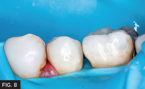 Fig. 8) Preparation has been over-filled with 3M Filtek Supreme Ultra with the injection moulding technique.