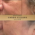 Cheek Fillers Wilmslow