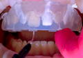 tray in place with syringe attached to dispense flowable composite