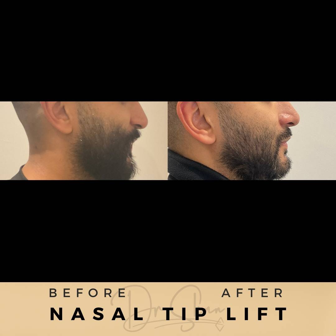 nasal droop treatment