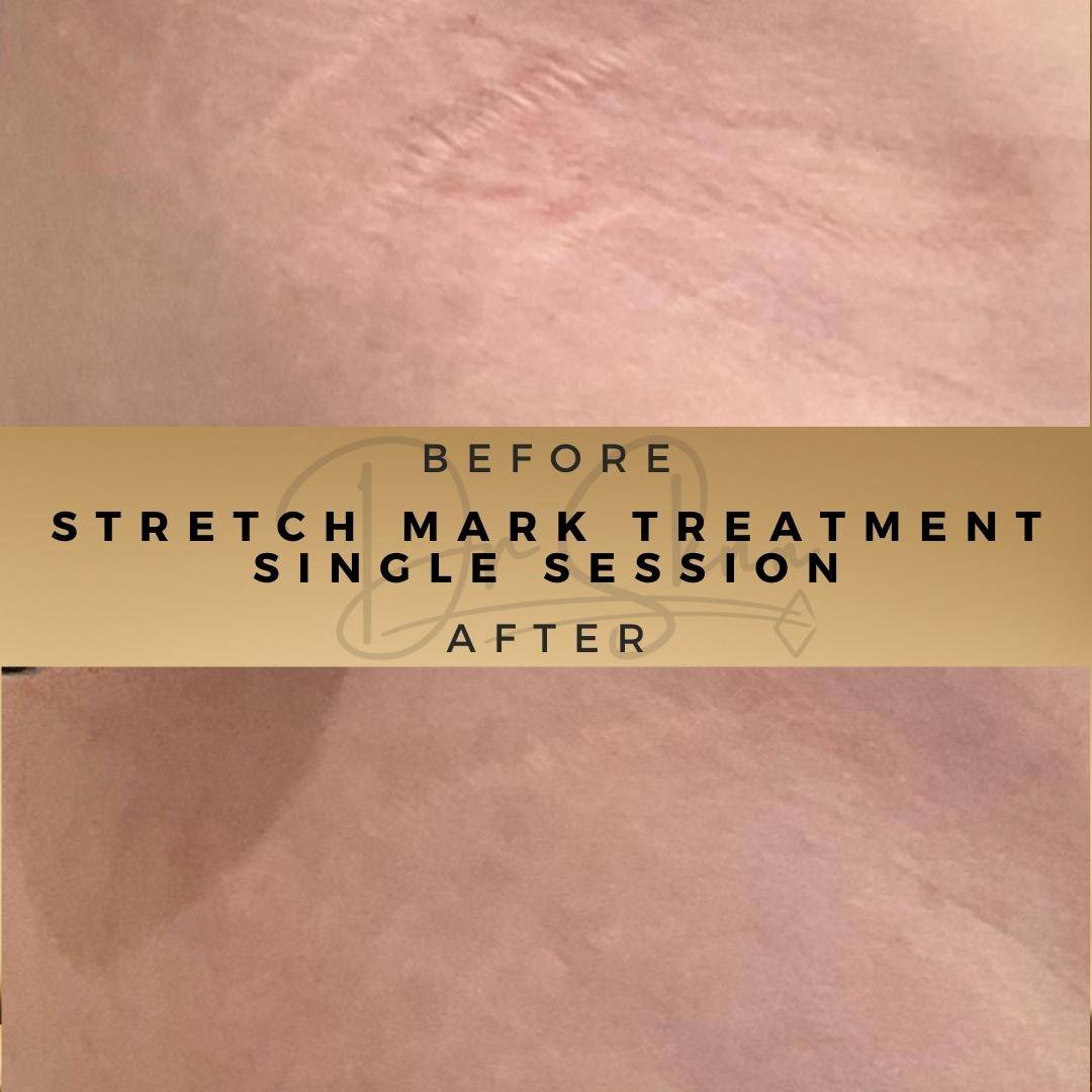 Stretch Mark Treatment - Dr Sknn before and after