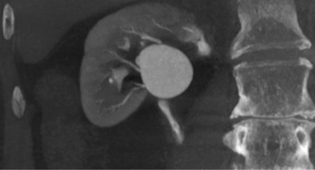aneurysm scan image