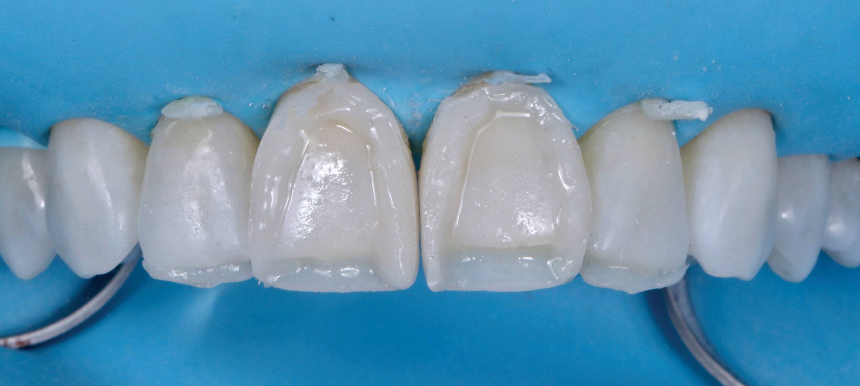 Incisors prefilled with veneer material roughly