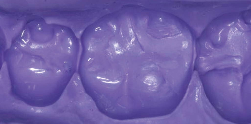 Purple impression material with molars impressed into it