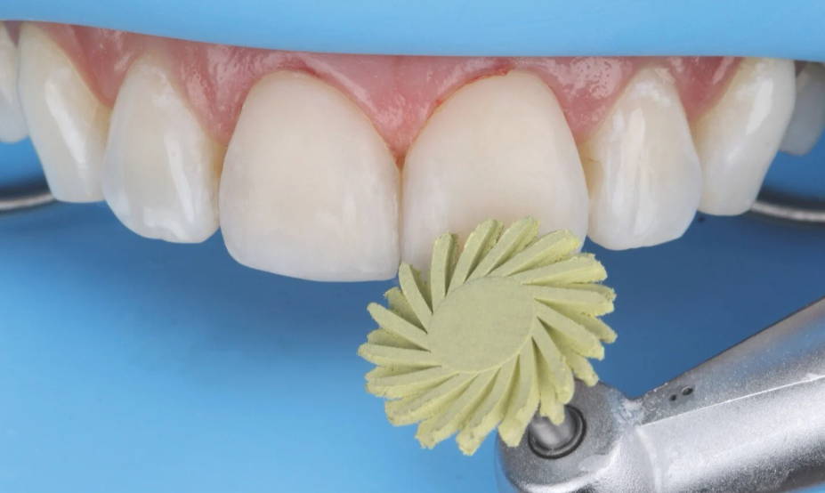 yellow polisher being used on tooth