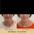 Nasolabial Fold Fillers Wilmslow