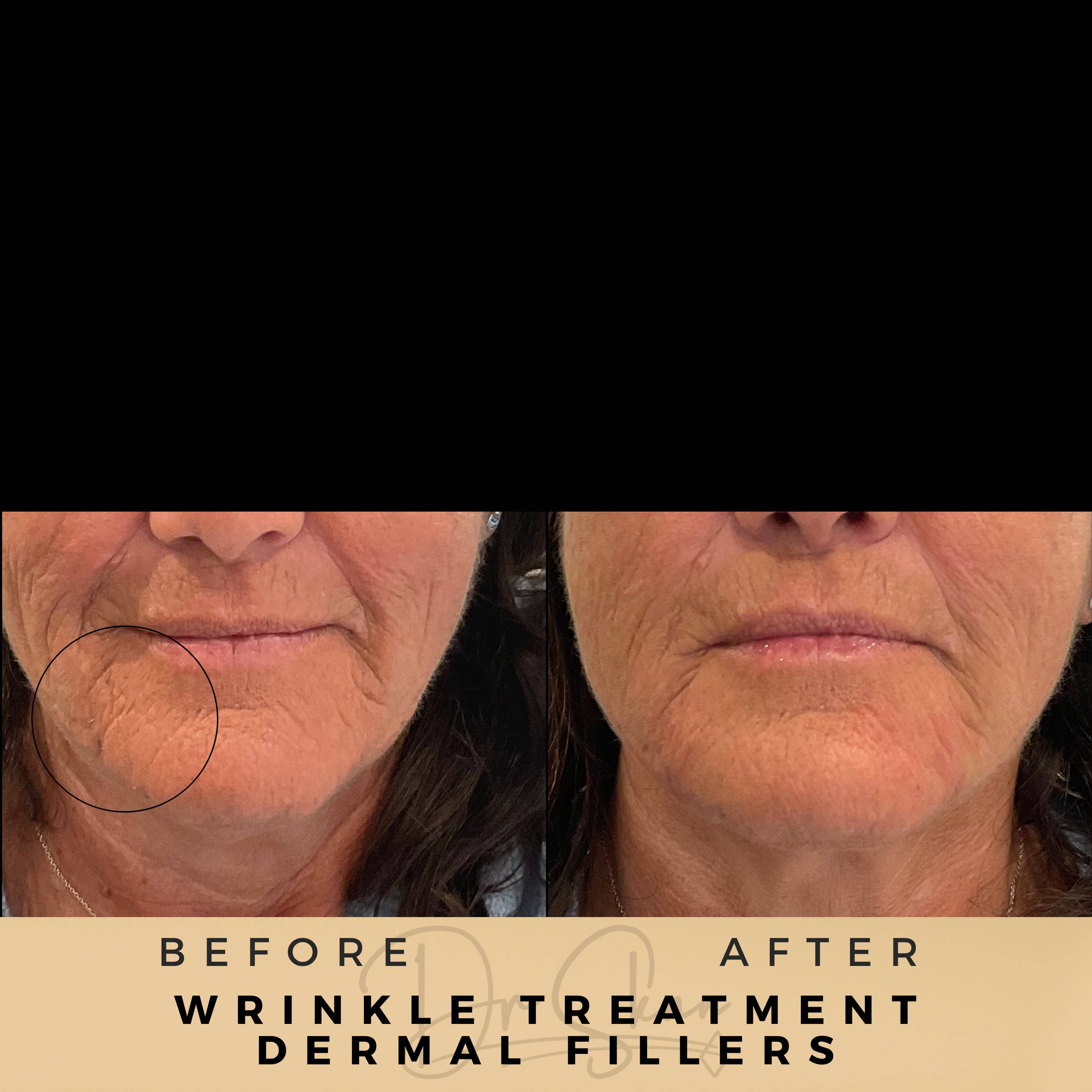 Perioral Fillers - Dr Sknn before and after