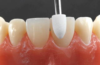White polishing cup touching anterior tooth