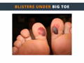 Blisters under big toe