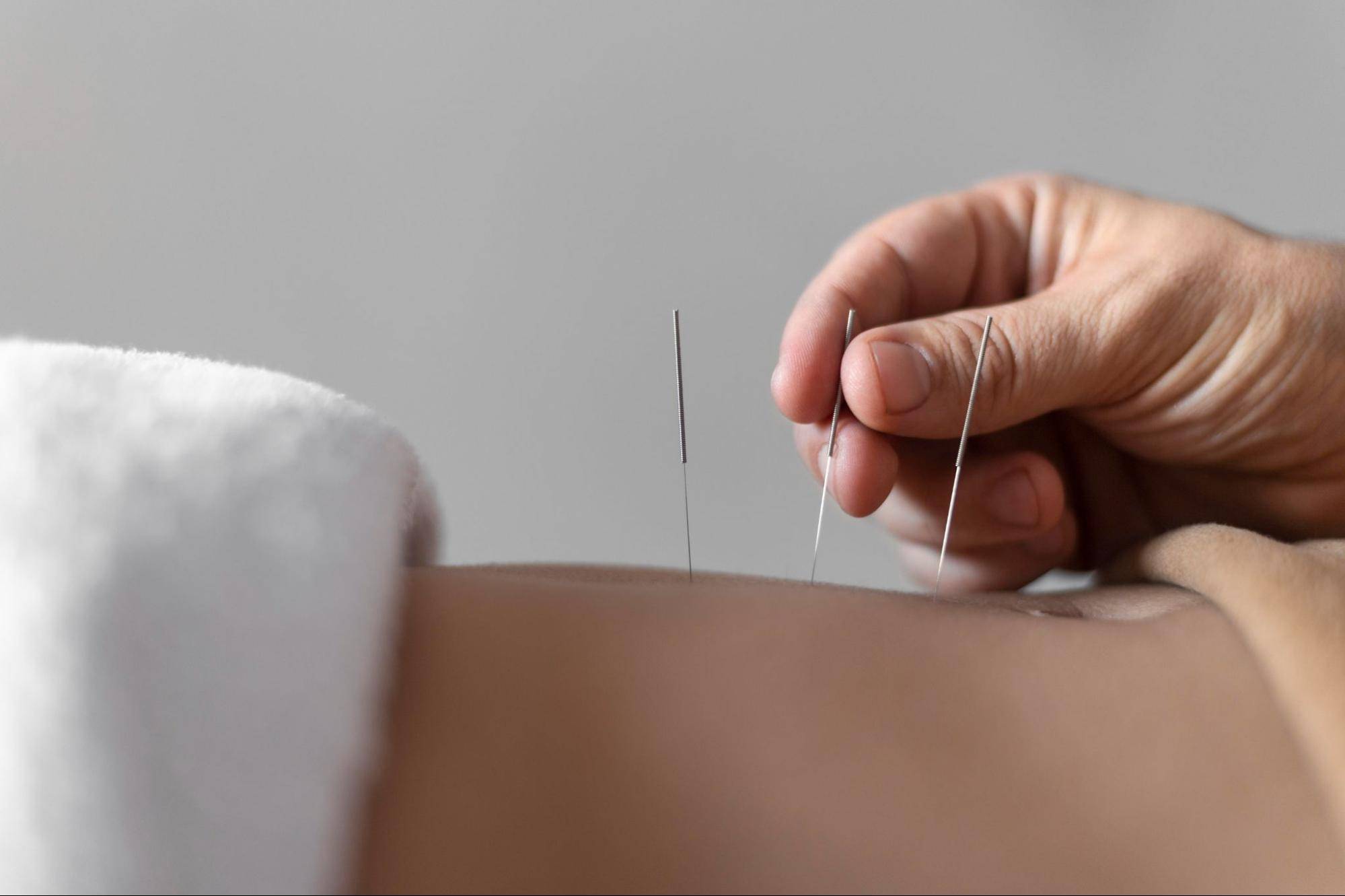 A person receiving acupuncture treatment