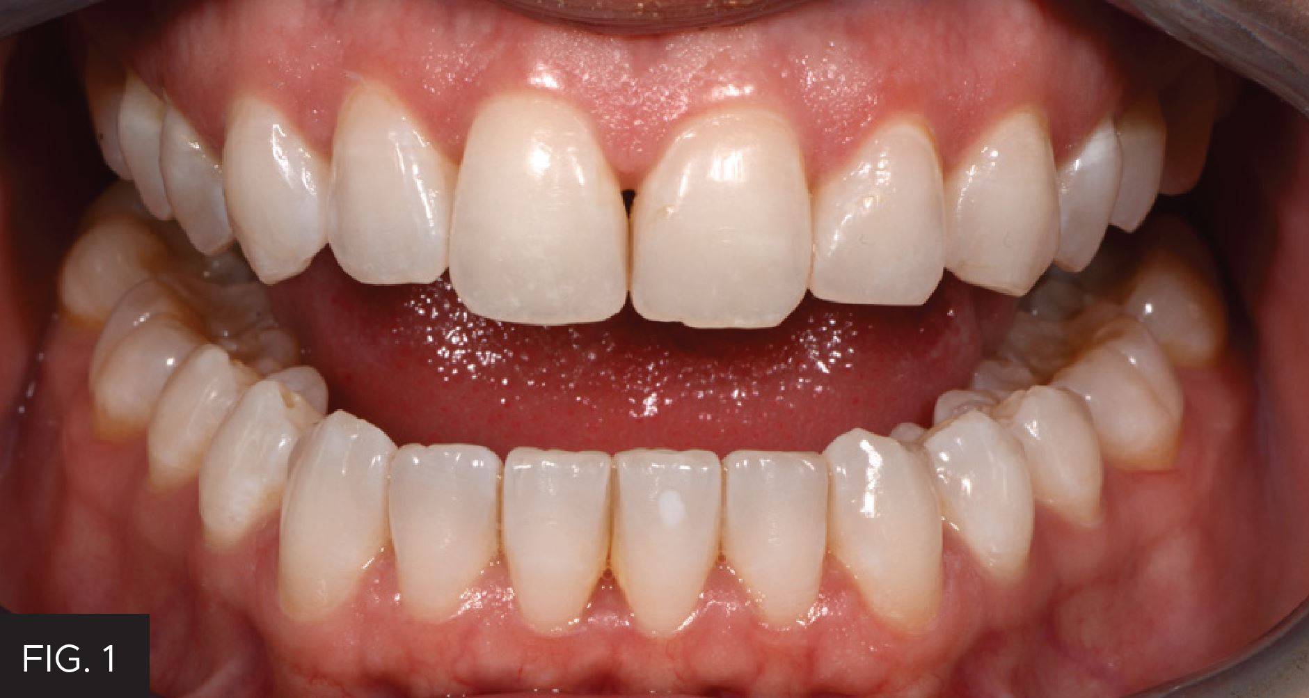 Gingival Sculpting With a Soft Tissue Diode Laser: Figure 1