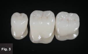 a ready to be cemented monolithic zirconia tooth crown