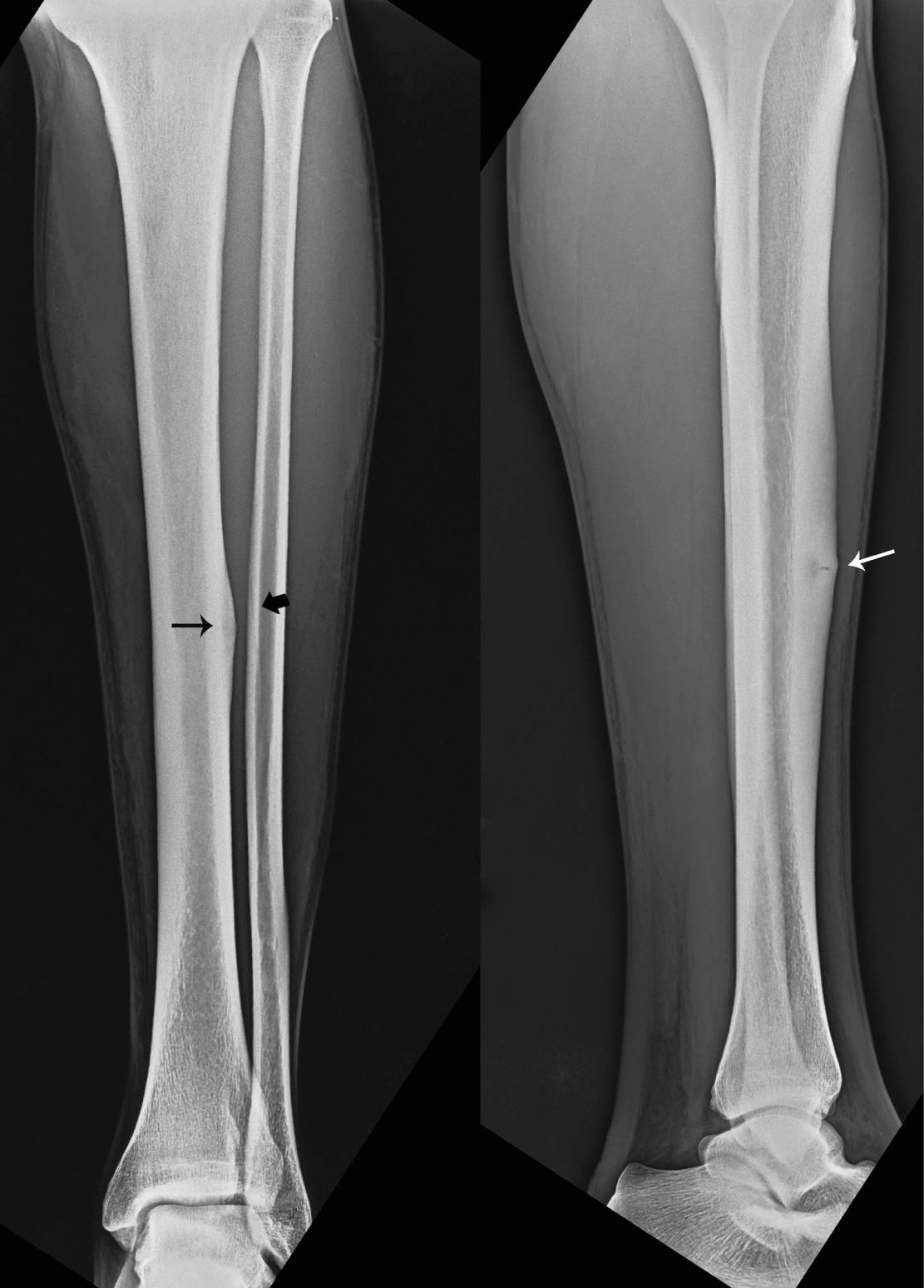 Anterior tibial stress syndrome