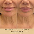 Lip Fillers Wilmslow with Anti-wrinkle injections