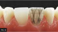 Depressions drawn with pencil on tooth
