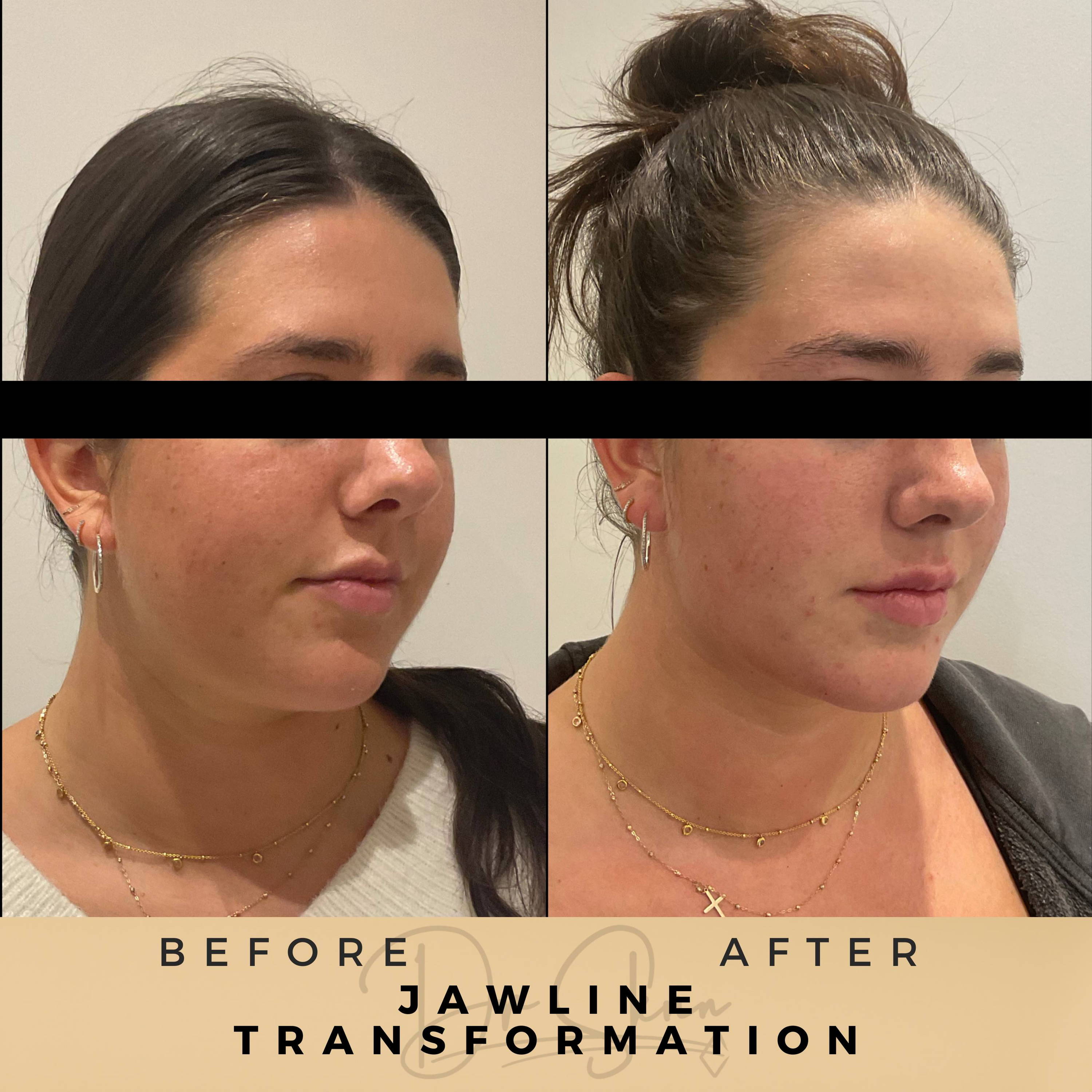 Transformations Aesthetic Clinic Wilmslow Before & After Dr Sknn