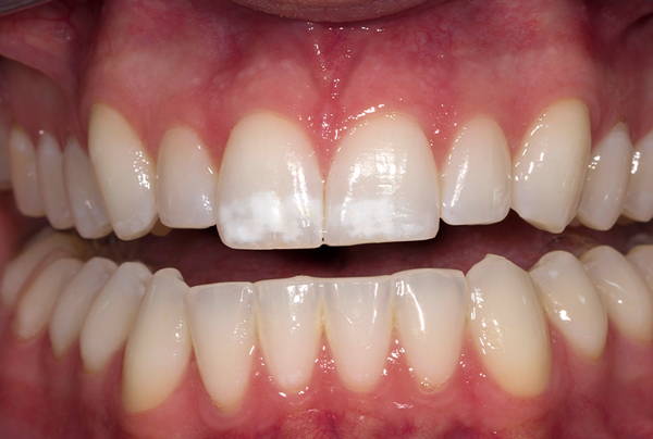Opalescence teeth: before