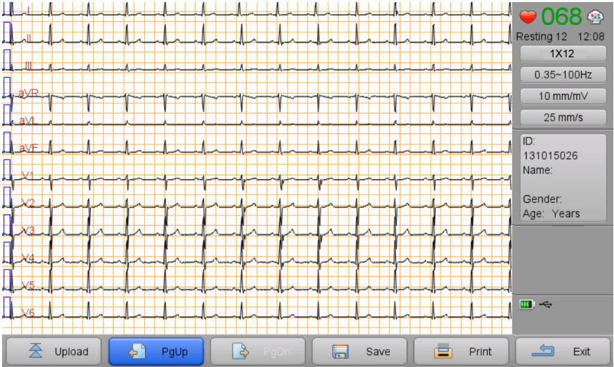 Wellue Biocare iE300 EKG-Maschinenanalysebericht 2 Schnittstelle mit 12-Kanal-Wellenformen.