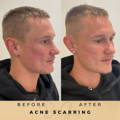 Acne Scarring Treatment Co2 Fractional Laser Wilmslow Dr Sknn Before & After Picture
