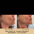 Perioral Line Fillers Wilmslow Before & After