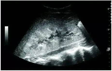 Postoperative renal failure image scanned by EagleView portable ultrasound.