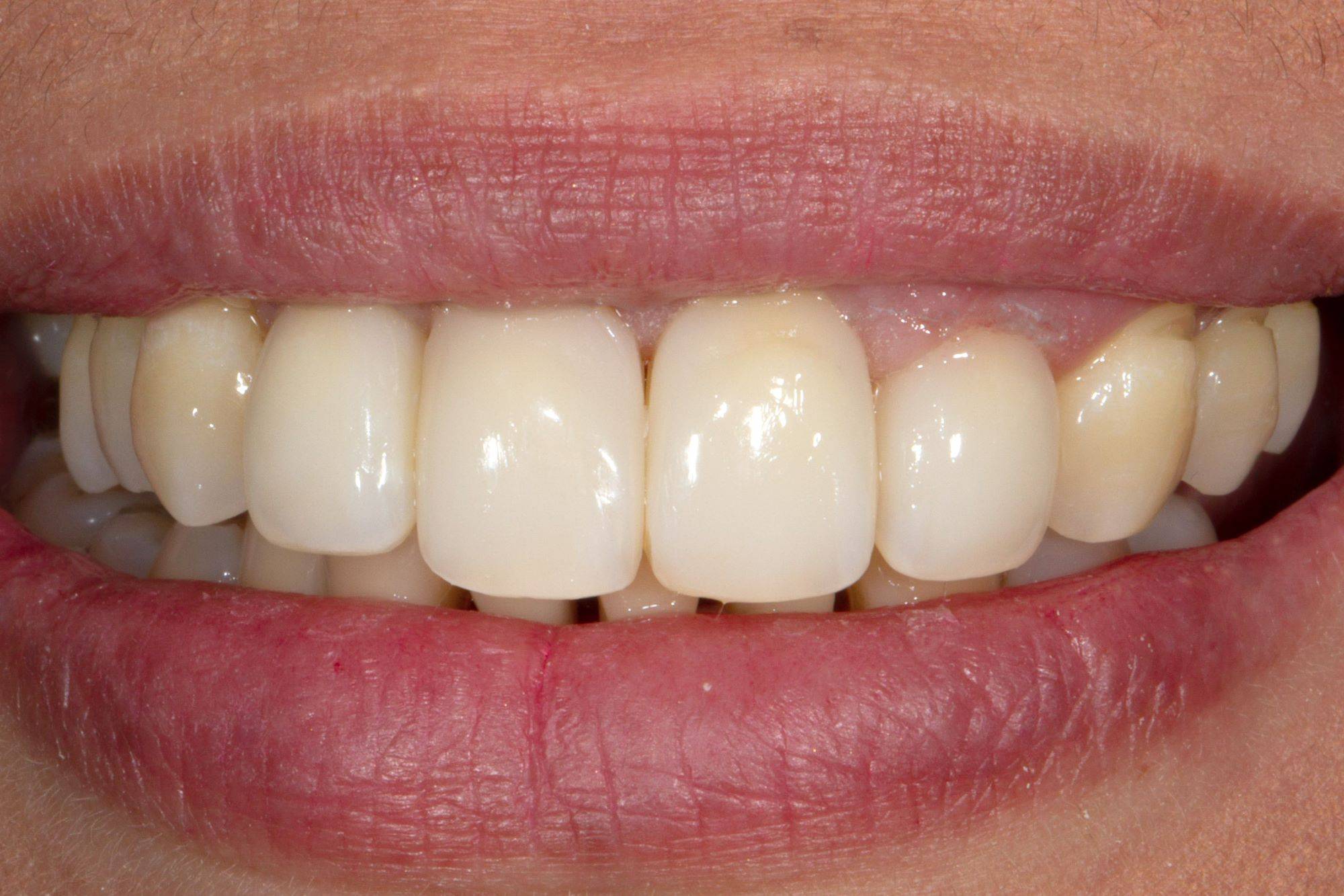 Close-up in smile after restorative procedure