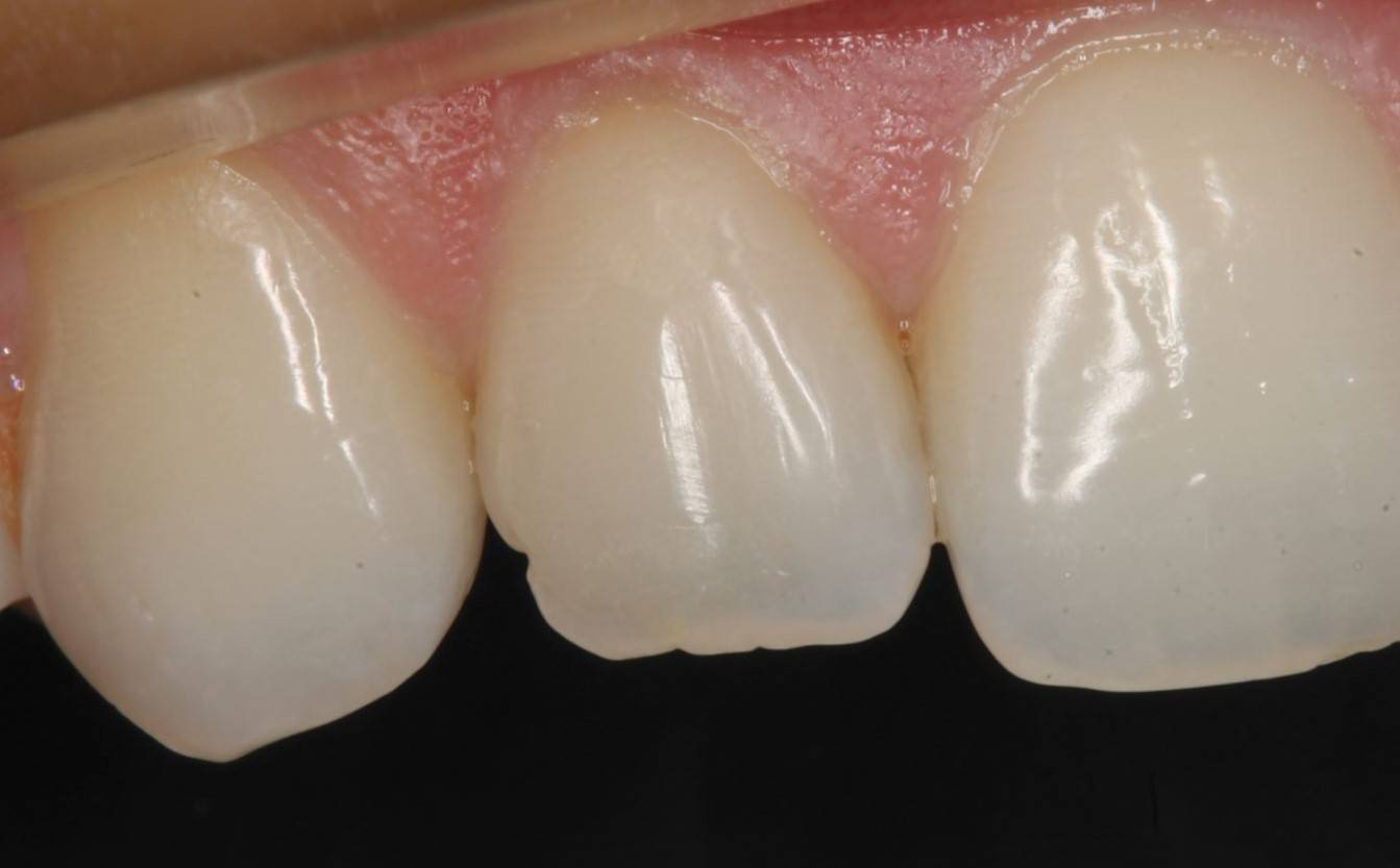 Close-up on lateral defective tooth