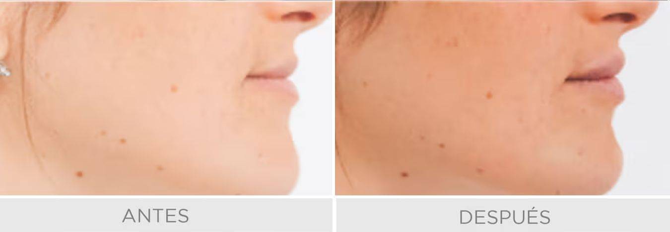 labios hialuronico romedical