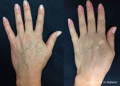 Woman's hand before and after Lumecca IPL for pigment