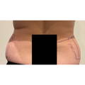 ONDA - Non-surgical Skin Tightening / Fat Reduction - Three Area - Before