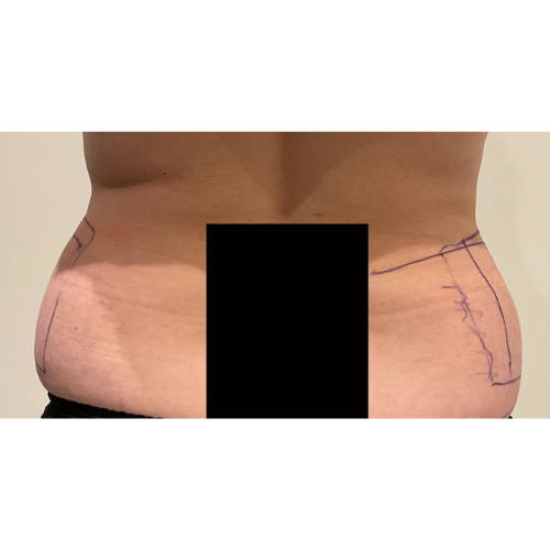 ONDA - Non-surgical Skin Tightening / Fat Reduction - Three Area - Before